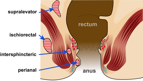 analni absces in fistula