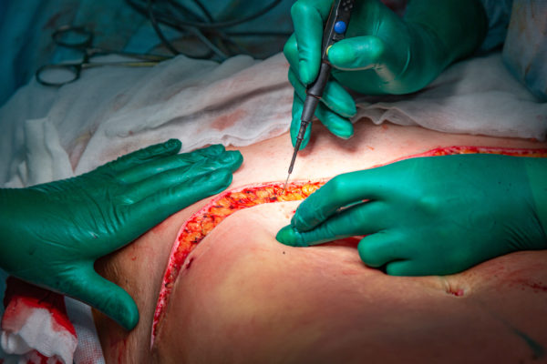 abdominoplastika, operacija, kirurška korekcija trebuha