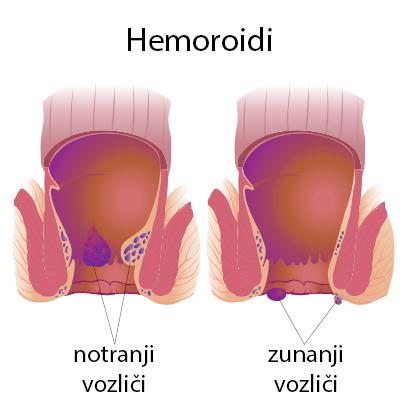 hemoroidi, shematski anatomski prikaz