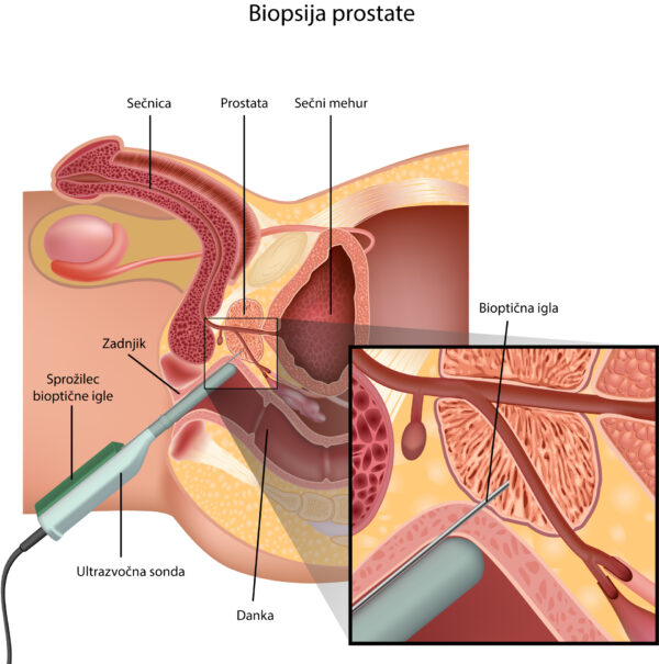 biopsija prostate zaradi suma na rak prostate, rak na prostati