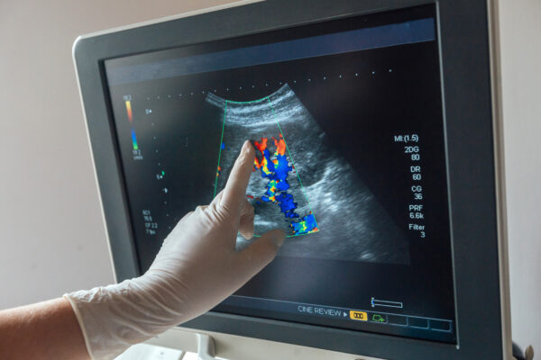 Slika ultrazvoka s prikazom pretoka krvi v tkivu